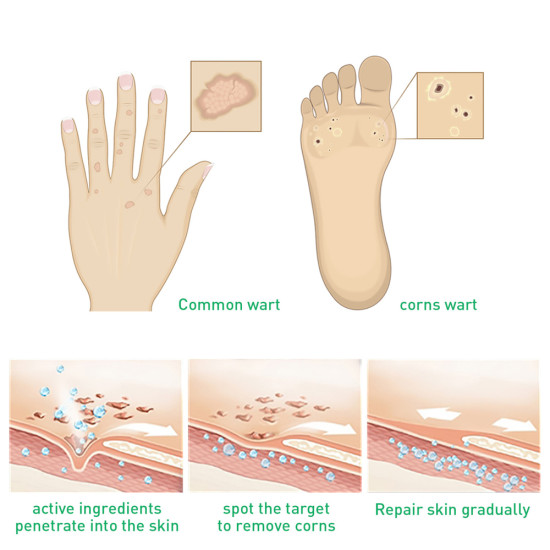 "Gentle Wart & Corn Remover – Smooth Skin & Foot Care"