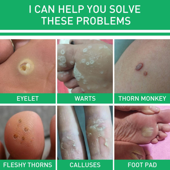 "Gentle Wart & Corn Remover – Smooth Skin & Foot Care"
