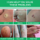 "Gentle Wart & Corn Remover – Smooth Skin & Foot Care"